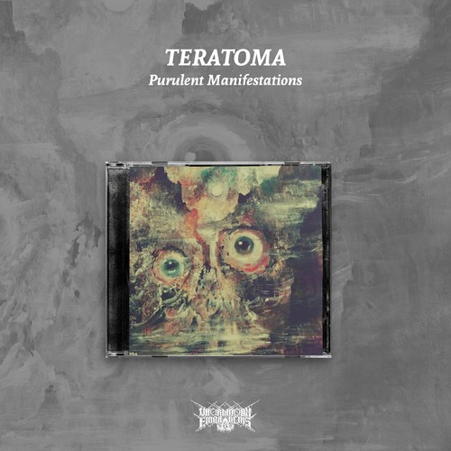 Teratoma purulent - (ger),